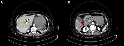 Peptic ulcer disease complicated with choledocho-duodenal fistula and gastro-intestinal bleeding: a case report and review of the literature